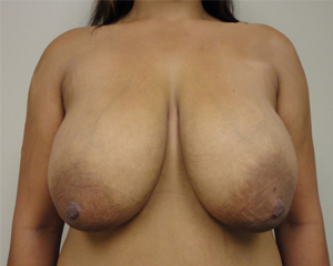 Breast Reduction Before and After Pictures Nashville, TN