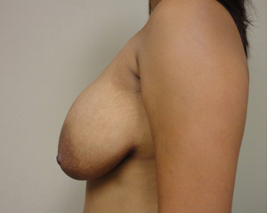 Breast Reduction Before and After Pictures Nashville, TN