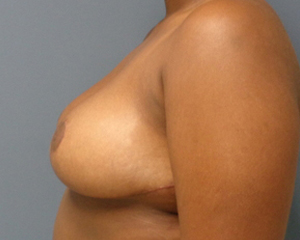 Breast Reduction Before and After Pictures Nashville, TN