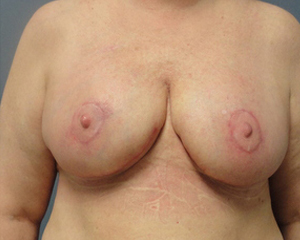 Breast Reduction Before and After Pictures Nashville, TN