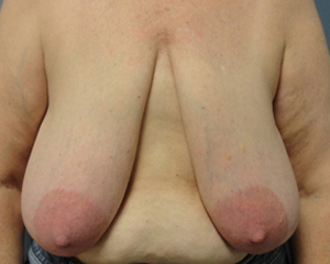 Breast Reduction Before and After Pictures Nashville, TN