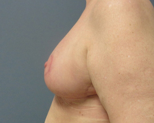 Breast Reduction Before and After Pictures Nashville, TN