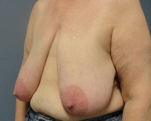 Breast Reduction Before and After Pictures Nashville, TN