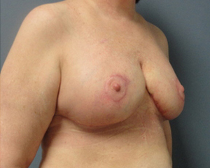 Breast Reduction Before and After Pictures Nashville, TN