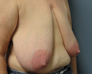 Breast Reduction Before and After Pictures Nashville, TN