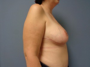 Breast Reduction Before and After Pictures Nashville, TN