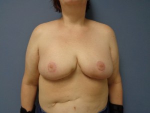 Breast Reduction Before and After Pictures Nashville, TN