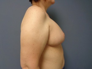 Breast Reduction Before and After Pictures Nashville, TN