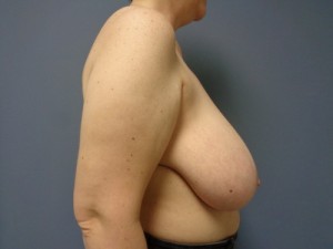 Breast Reduction Before and After Pictures Nashville, TN