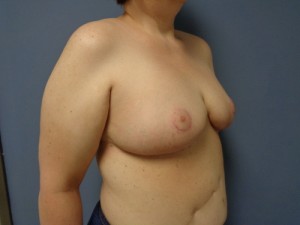 Breast Reduction Before and After Pictures Nashville, TN