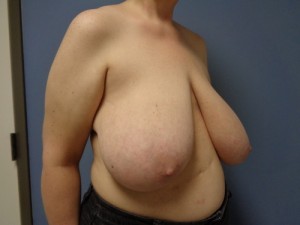 Breast Reduction Before and After Pictures Nashville, TN