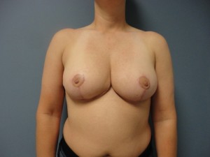 Breast Reduction Before and After Pictures Nashville, TN