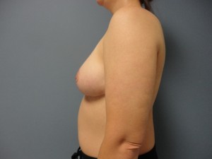 Breast Reduction Before and After Pictures Nashville, TN