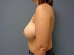 Breast Reduction Before and After Pictures Nashville, TN