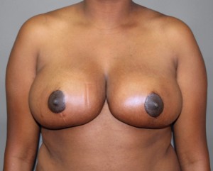 Breast Reduction Before and After Pictures Nashville, TN