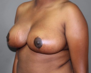Breast Reduction Before and After Pictures Nashville, TN
