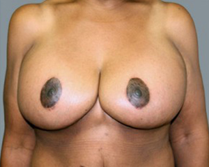 Breast Lift Before and After Pictures Nashville, TN