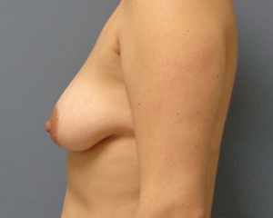 Breast Lift Before and After Pictures Nashville, TN