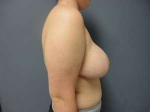 Capsular Contracture Reconstruction Before and After Pictures Nashville, TN