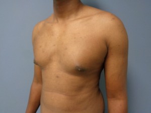 Gynecomastia Before and After Pictures Nashville, TN