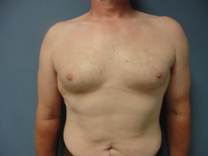 Gynecomastia Before and After Pictures Nashville, TN