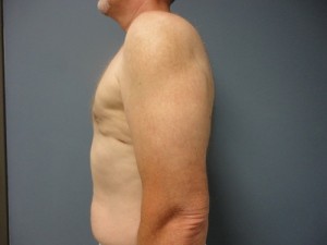 Gynecomastia Before and After Pictures Nashville, TN