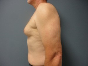 Gynecomastia Before and After Pictures Nashville, TN