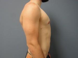 Gynecomastia Before and After Pictures Nashville, TN