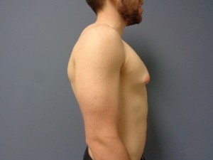 Gynecomastia Before and After Pictures Nashville, TN