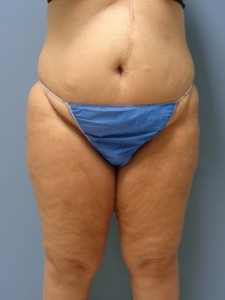 Liposuction Before and After Pictures Nashville, TN