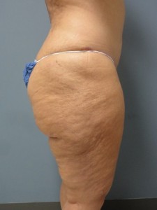 Liposuction Before and After Pictures Nashville, TN