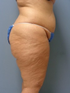 Liposuction Before and After Pictures Nashville, TN