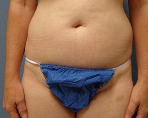 Liposuction Before and After Pictures Nashville, TN