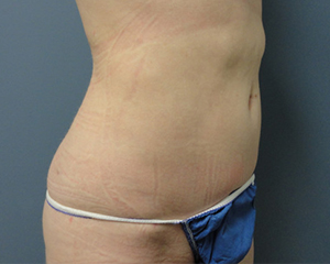 Liposuction Before and After Pictures Nashville, TN