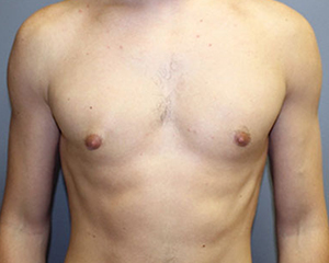 Gynecomastia Before and After Pictures Nashville, TN