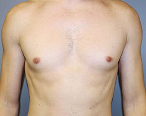 Gynecomastia Before and After Pictures Nashville, TN