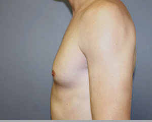 Gynecomastia Before and After Pictures Nashville, TN