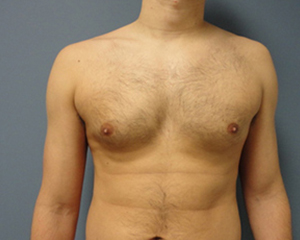 Gynecomastia Before and After Pictures Nashville, TN