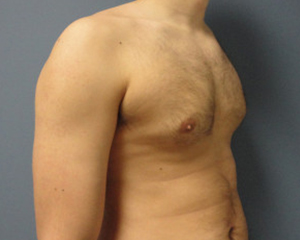 Gynecomastia Before and After Pictures Nashville, TN