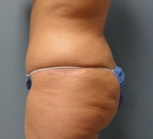 Tummy Tuck Before and After Pictures Nashville, TN