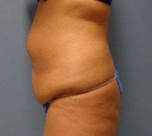 Tummy Tuck Before and After Pictures Nashville, TN