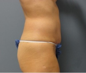 Tummy Tuck Before and After Pictures Nashville, TN