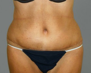 Tummy Tuck Before and After Pictures Nashville, TN