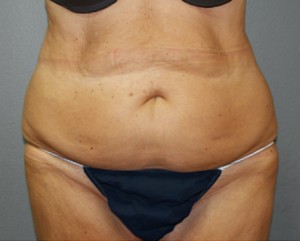 Tummy Tuck Before and After Pictures Nashville, TN