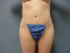 Tummy Tuck Before and After Pictures Nashville, TN