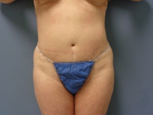 Tummy Tuck Before and After Pictures Nashville, TN