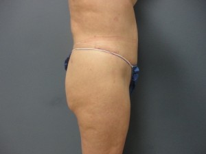 Tummy Tuck Before and After Pictures Nashville, TN