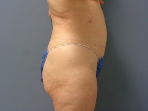 Tummy Tuck Before and After Pictures Nashville, TN