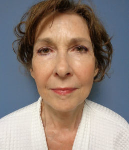 Facelift Before and After Pictures Nashville, TN