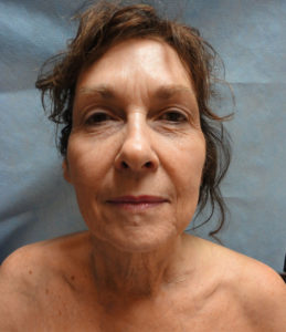 Facelift Before and After Pictures Nashville, TN